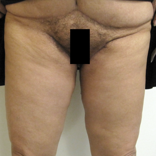 Medial Thigh Lift After